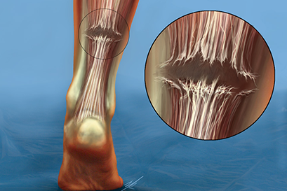 bam klinik asil tendon zedelenmesi